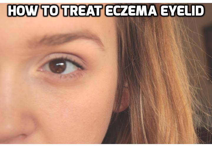 How To Prevent And Treat Eczema On Eyelid 