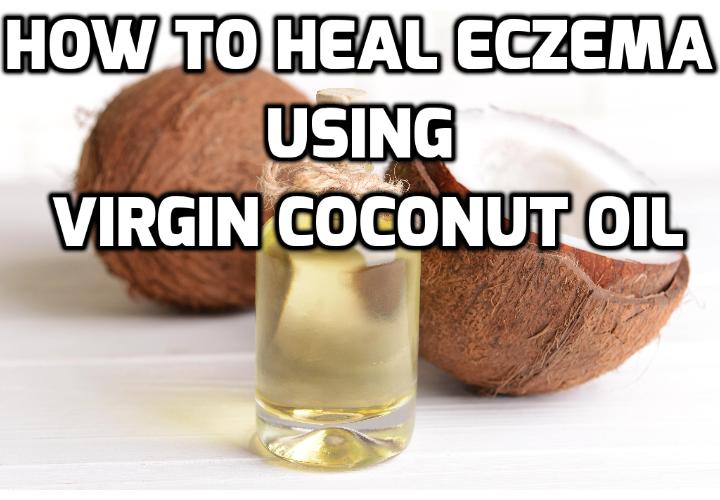 Coconut Oil As An Effective Eczema Alternative Treatment